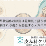 貨幣状湿疹の原因は乾燥肌と掻き壊し｜虫刺されや傷から悪化するメカニズム