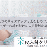 オムツのサイズアップと太もものゴム跡｜ギャザーの締め付けによる接触皮膚炎