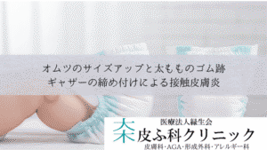 オムツのサイズアップと太もものゴム跡|ギャザーの締め付けによる接触皮膚炎