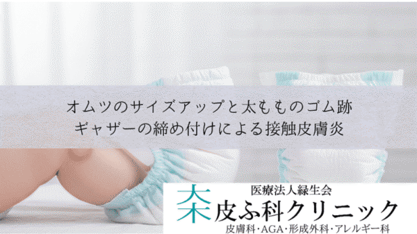 オムツのサイズアップと太もものゴム跡｜ギャザーの締め付けによる接触皮膚炎