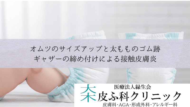 オムツのサイズアップと太もものゴム跡|ギャザーの締め付けによる接触皮膚炎