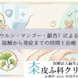 植物（ウルシ・マンゴー・銀杏）によるかぶれ｜接触から発症までの時間と治療