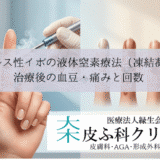 ウイルス性イボの液体窒素療法（凍結凝固）｜治療後の血豆・痛みと回数