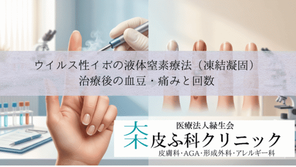 ウイルス性イボの液体窒素療法（凍結凝固）｜治療後の血豆・痛みと回数