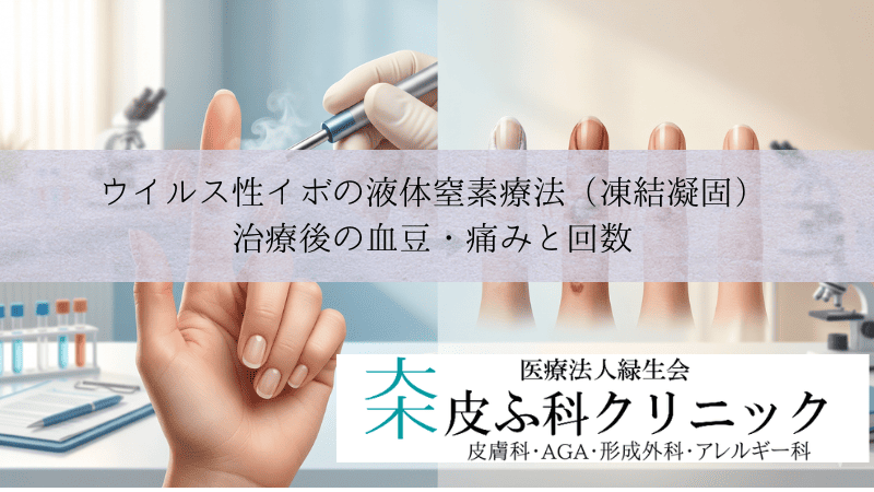 ウイルス性イボの液体窒素療法（凍結凝固）｜治療後の血豆・痛みと回数
