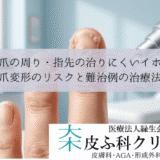 爪の周り・指先の治りにくいイボ｜爪変形のリスクと難治例の治療法