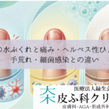 指先の水ぶくれと痛み・ヘルペス性ひょう疽｜手荒れ・細菌感染との違い