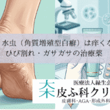 かかと水虫（角質増殖型白癬）は痒くない？｜ひび割れ・ガサガサの治療薬