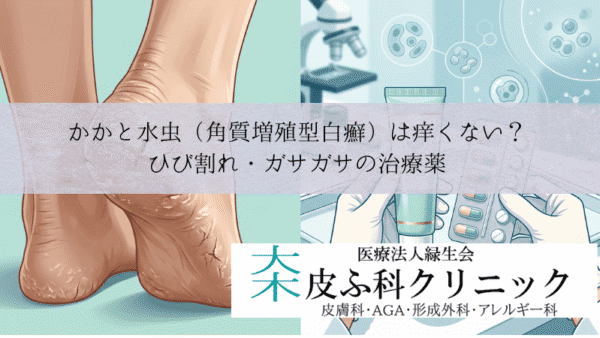 かかと水虫（角質増殖型白癬）は痒くない？｜ひび割れ・ガサガサの治療薬