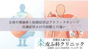 全身の蕁麻疹と粘膜症状はアナフィラキシー？｜皮膚症状だけの段階との違い