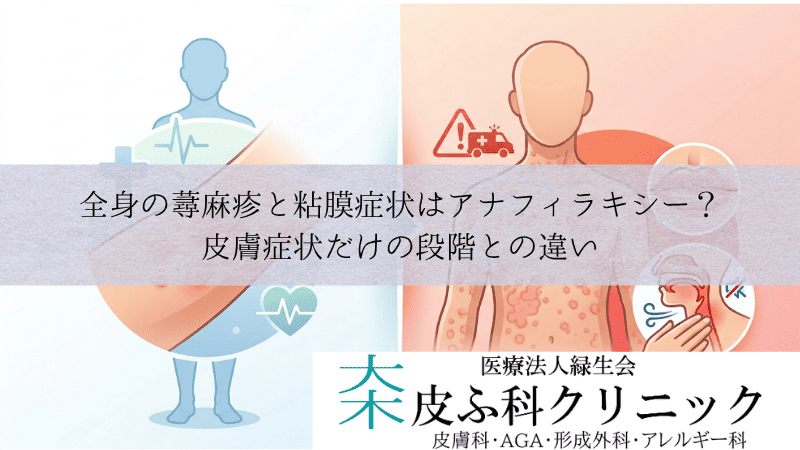 全身の蕁麻疹と粘膜症状はアナフィラキシー？｜皮膚症状だけの段階との違い