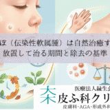水いぼ（伝染性軟属腫）は自然治癒する？｜放置して治る期間と除去の基準