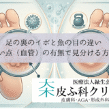 足の裏のイボと魚の目の違い｜黒い点（血管）の有無で見分ける方法