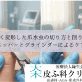 分厚く変形した爪水虫の切り方と削り処置｜ニッパーとグラインダーによるケア
