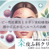 アトピー性皮膚炎とカポジ水痘様発疹症｜顔中に広がるヘルペスの治療