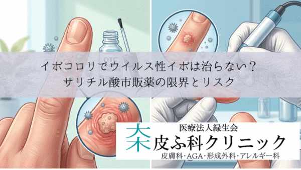 イボコロリでウイルス性イボは治らない？｜サリチル酸市販薬の限界とリスク