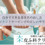 自分でできる巻き爪の治し方｜コットンパッキングとテーピングの正しいやり方』
