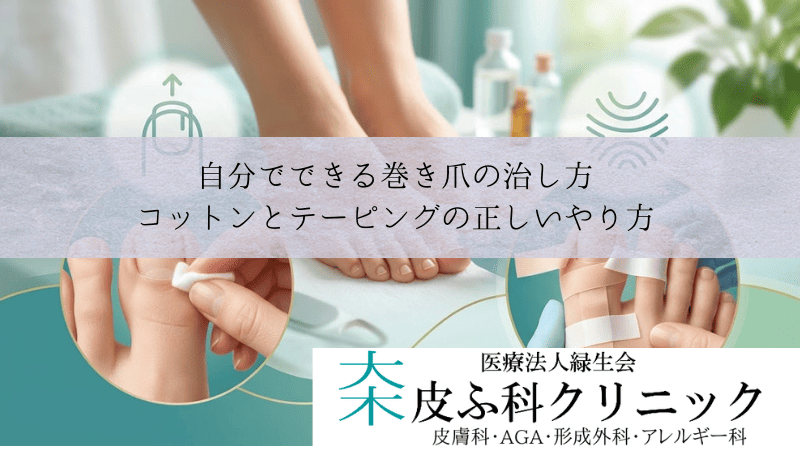 自分でできる巻き爪の治し方|コットンパッキングとテーピングの正しいやり方』