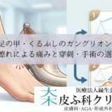 足の甲・くるぶしのガングリオン｜靴擦れによる痛みと穿刺・手術の選択