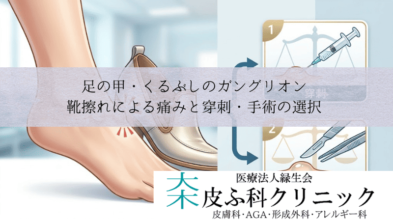 足の甲・くるぶしのガングリオン｜靴擦れによる痛みと穿刺・手術の選択