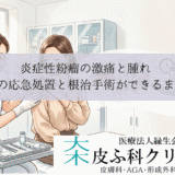 炎症性粉瘤の激痛と腫れ｜切開排膿の応急処置と根治手術ができるまでの期間