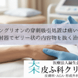 ガングリオンの穿刺吸引処置は痛い？｜注射器でゼリー状の内容物を抜く治療