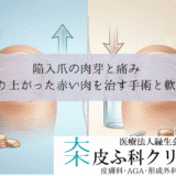 陥入爪の肉芽と痛み｜盛り上がった赤い肉を治すフェノール法手術と軟膏