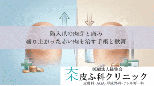 陥入爪の肉芽と痛み｜盛り上がった赤い肉を治すフェノール法手術と軟膏