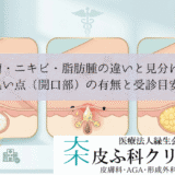 粉瘤・ニキビ・脂肪腫の違いと見分け方｜黒い点（開口部）の有無と受診目安