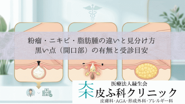 粉瘤・ニキビ・脂肪腫の違いと見分け方｜黒い点（開口部）の有無と受診目安