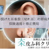 耳たぶが裂けた耳垂裂（切れ耳）の形成外科手術｜保険適用と修正費用