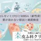 治らないとびひとMRSA（耐性菌）｜薬が効かない原因と細菌検査