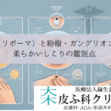 脂肪腫（リポーマ）と粉瘤・ガングリオンの違い｜柔らかいしこりの鑑別点