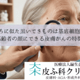ほくろに似た黒いできものは基底細胞癌？｜高齢者の顔にできる皮膚がんの特徴