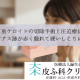 耳垂ケロイドの切除手術と圧迫療法｜ピアス跡が赤く腫れて硬いしこりに