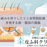 痛みを伴うしこりと血管脂肪腫（アンギオリポーマ）｜多発する腕・腹部の腫瘍