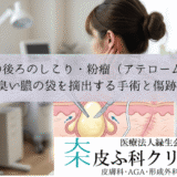 耳の後ろのしこり・粉瘤（アテローム）｜臭い膿の袋を摘出する手術と傷跡