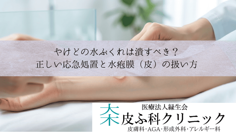 やけどの水ぶくれは潰すべき?|正しい応急処置と水疱膜(皮)の扱い方