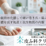 足の親指が化膿して痛い巻き爪・陥入爪｜膿を出す処置と抗生物質の内服