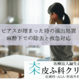 ピアスが埋まった・キャッチが取れない時の摘出処置｜麻酔下での除去と救急対応