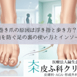 巻き爪の原因は浮き指と歩き方？｜再発を防ぐ足の裏の使い方とインソール