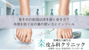 巻き爪の原因は浮き指と歩き方?|再発を防ぐ足の裏の使い方とインソール