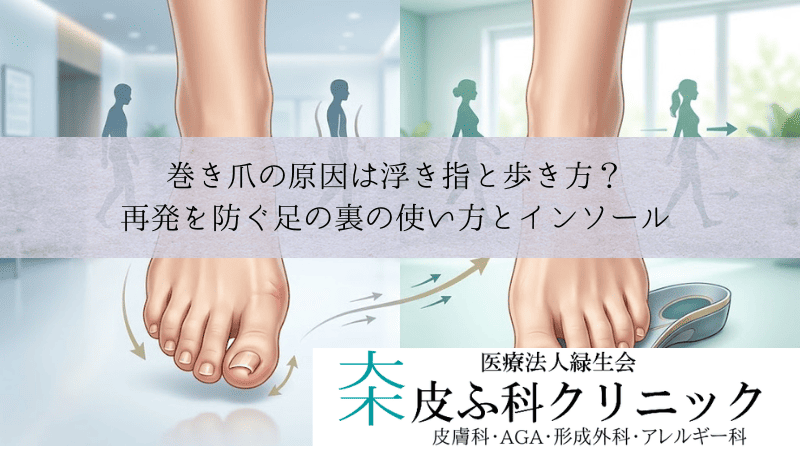 巻き爪の原因は浮き指と歩き方？｜再発を防ぐ足の裏の使い方とインソール
