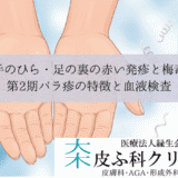 手のひら・足の裏の赤い発疹と梅毒｜第2期バラ疹の特徴と血液検査