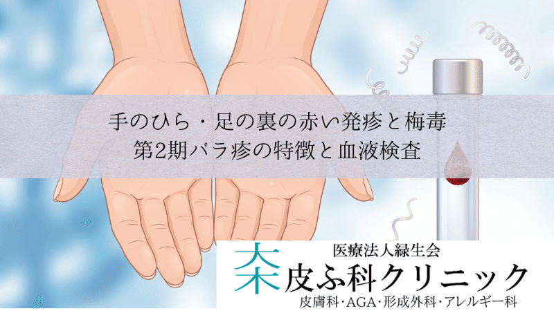 手のひら・足の裏の赤い発疹と梅毒｜第2期バラ疹の特徴と血液検査