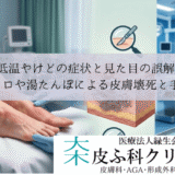 低温やけどの症状と見た目の誤解｜カイロや湯たんぽによる皮膚壊死と手術