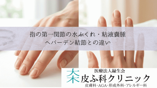 指の第一関節の水ぶくれ・粘液嚢腫（ミューカスシスト）｜ヘバーデン結節との違い
