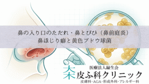 鼻の入り口のただれ・鼻とびひ(鼻前庭炎)|鼻ほじり癖と黄色ブドウ球菌