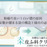 粉瘤の臭いと白い膿の原因｜垢と皮脂が溜まる袋の構造と摘出の必要性