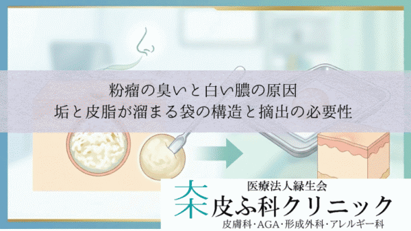 粉瘤の臭いと白い膿の原因｜垢と皮脂が溜まる袋の構造と摘出の必要性